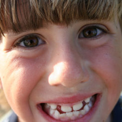Interceptive Orthodontics: The Basics